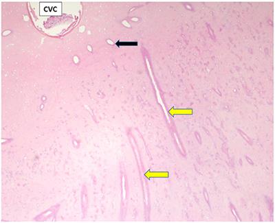 A Computed Tomographic and Pathological Study of Equine Cheek Teeth Infundibulae Extracted From Asymptomatic Horses. Part 2: MicroCT, Gross, and Histological Findings